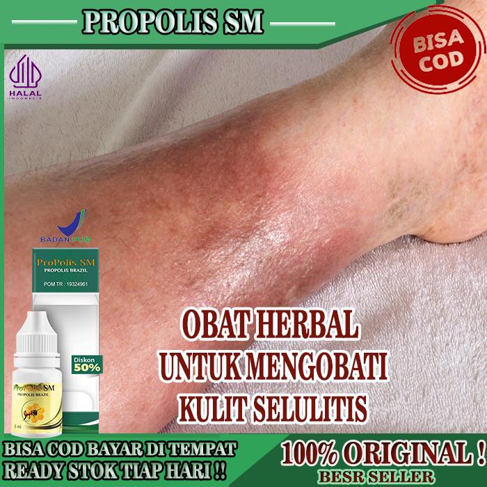 OBAT UNTUK SELULITIS RUAM KULIT KEMERAHAN, OBAT SELULITIS KAKI TANGAN BENGKAK KEMERAHAN, SELULITIS I