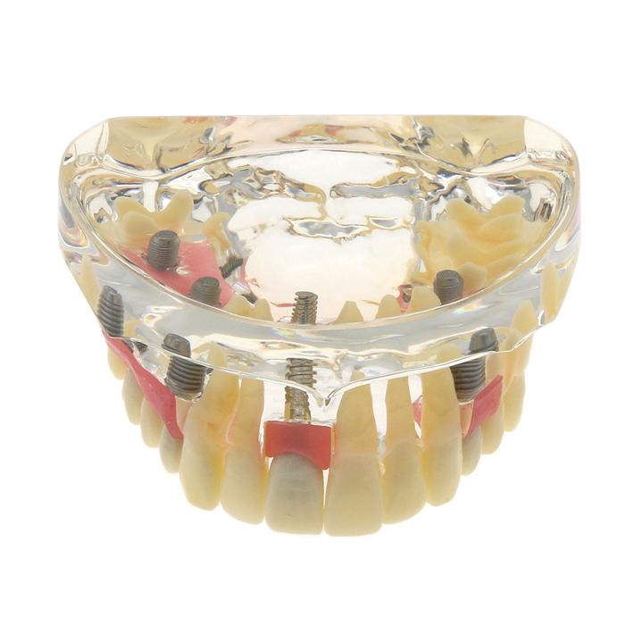 Model Gigi Implan Gigi Typodont Overdenture 2 3 4 Implan Atas