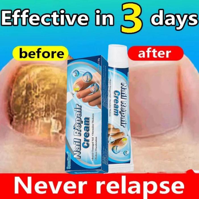 Nail Repair Cream Serum Kuku Perawatan Kuku Berjamur Cream Penghilang Jamur Di Kuku Vitamin Kuku Rus