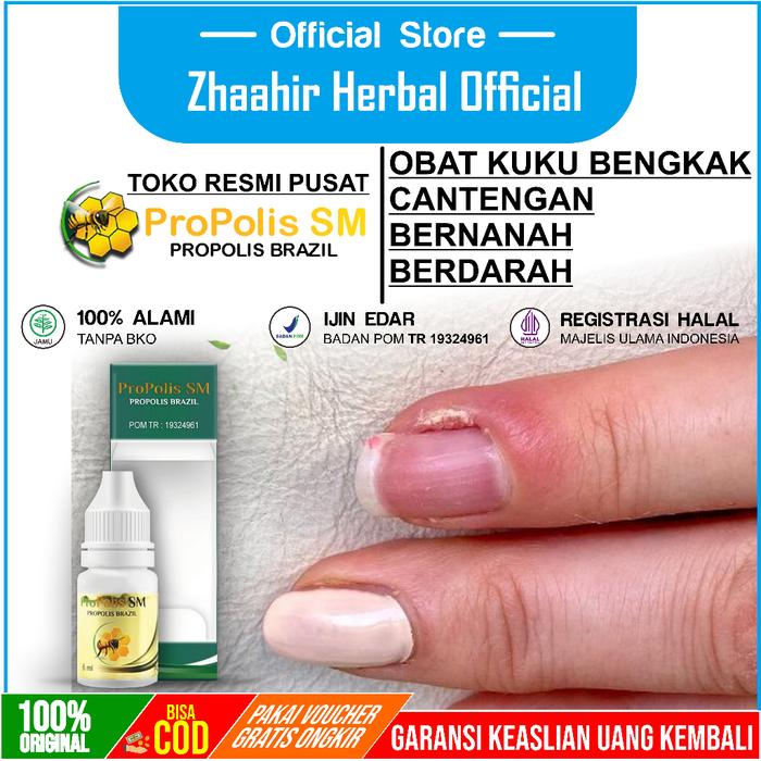 OBAT CANTENGAN JEMPOL KAKI - OBAT KUKU - KUKU RUSAK - SAKIT KUKU - KUKU BENGKAK - KUKU BERDARAH - KU