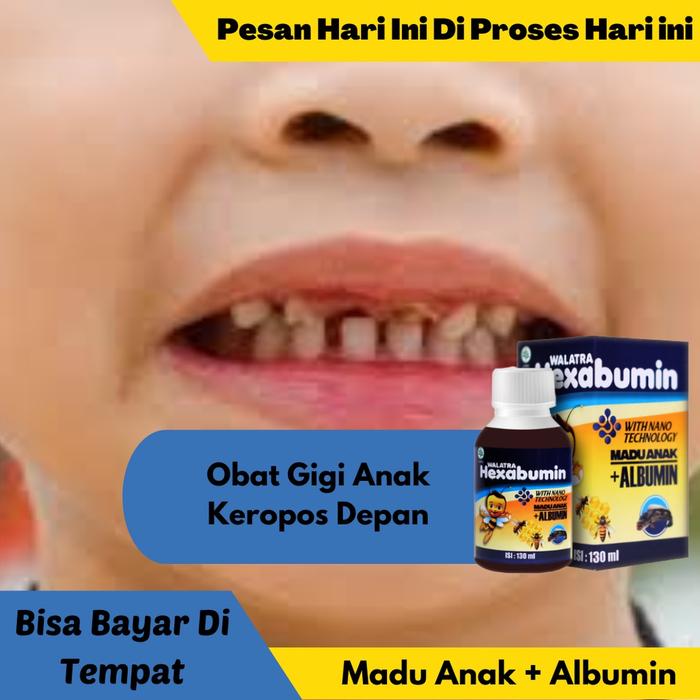 OBAT GIGI ANAK KEROPOS DEPAN , OBAT PERCEPAT PERTUMBUHAN GIGI PADA ANAK BATITA | HEXABUMIN