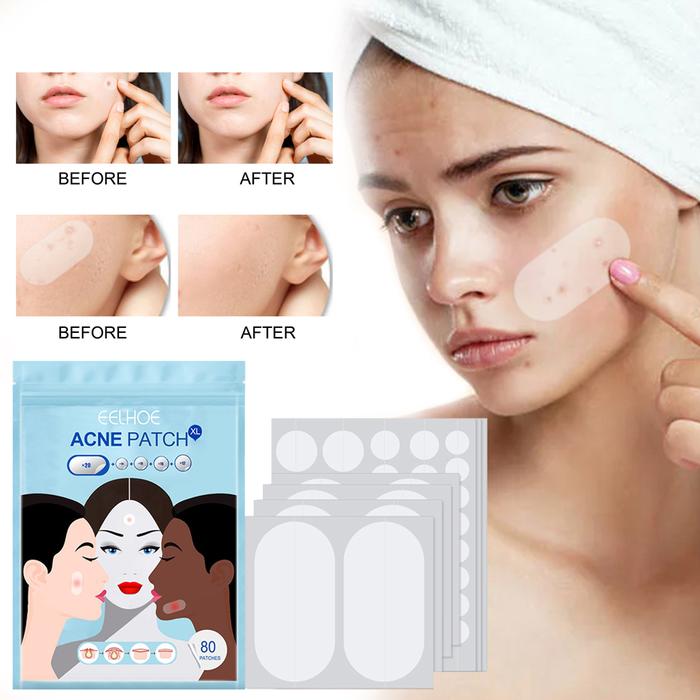 80pcs/Set Acne Acne Patch Large Size Acne Patch Hydrocolloid Bandage