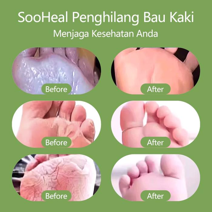 Soo Heal Obat Kutu Air Obat Jamur 30Ml Atasi Gatal & Jamur Dalam 1 Hari