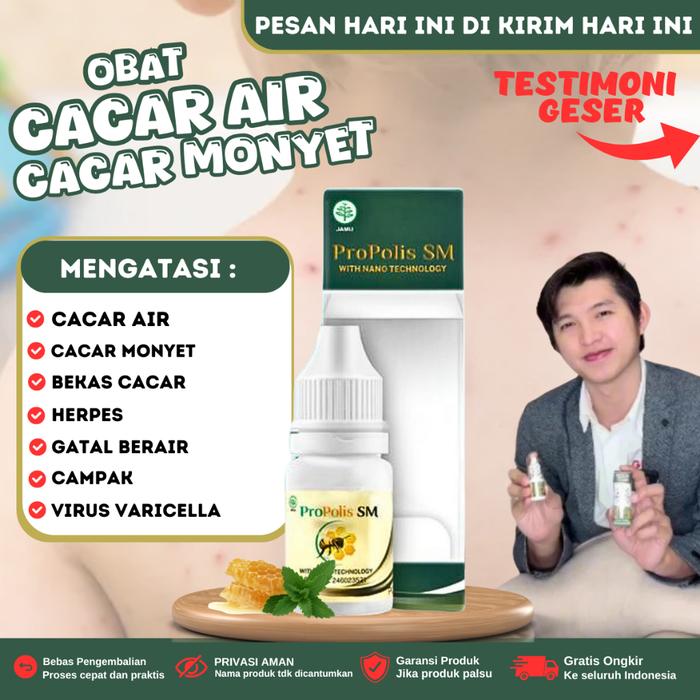 PROPOLIS SM - OBAT CACAR AIR & BEKAS CACAR, OBAT HERPES ZOSTER, OBAT GATAL BERAIR, SALEP CACAR AIR,