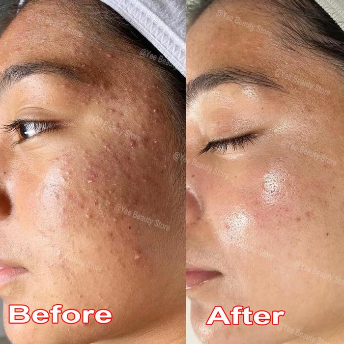 Pore Shrink Face Serum Acne Removal Serum Effective Moisturizing