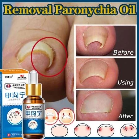 Obat Jamur Kuku Serum Kuku Perawatan Kuku Obat Kuku Jamur Dan Rusak Vitamin Kuku Dan Kutikula Obat K