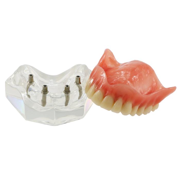 Model Gigi Implan Gigi M6001 Jelas Typodont Overdenture 4 Implan