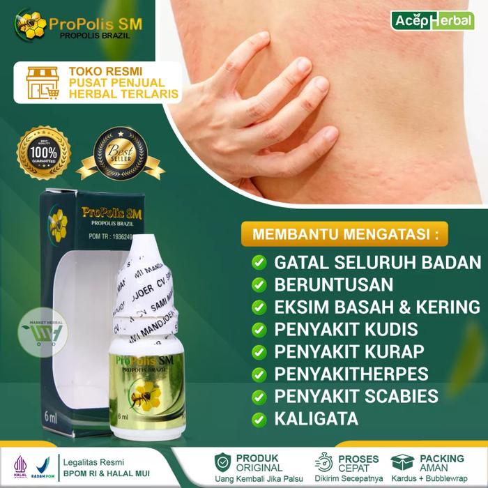 OBAT GATAL GATAL SELURUH BADAN EKSIM KERING BASAH KURAP KUDIS SCABIES CACAR PSORIASIS BUDUG MENAHUN