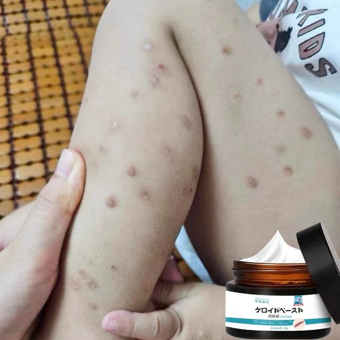 [Promo] Krim Penghilang Bekas Luka - Bekas Jahitan, Gigitan Nyamuk, Luka Bakar & Stretch Mark