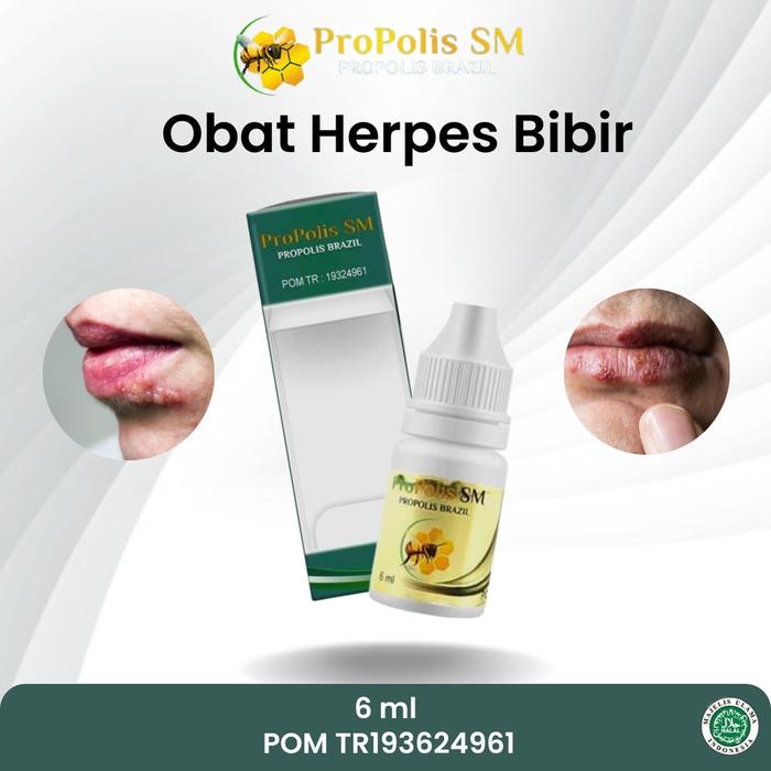 SAPNU HERBAL - OBAT HERPES BIBIR, HERPES MULUT, BINTIK BINTIK PUTIH DI BIBIR, LUKA MELEPUH SEKITAR B