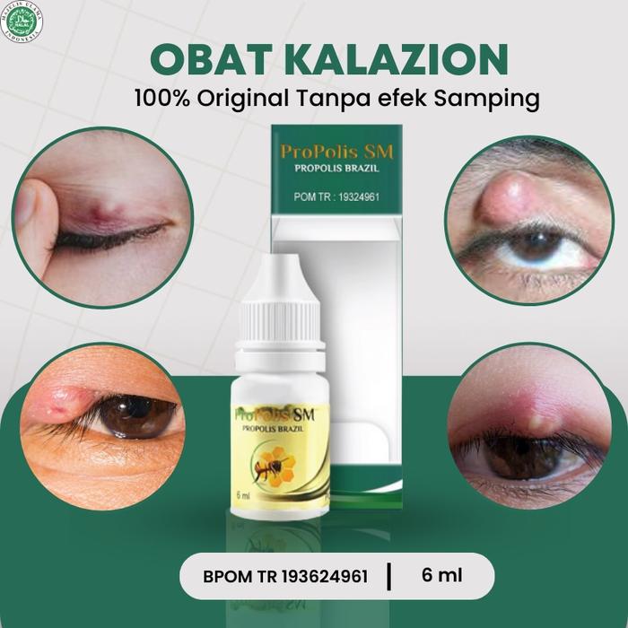 PROPOLIS SM - OBAT KALAZION MATA, OBAT MATA BINTITAN, OBAT OLES PENGHILANG MATA BINTITAN, OBAT BENJO