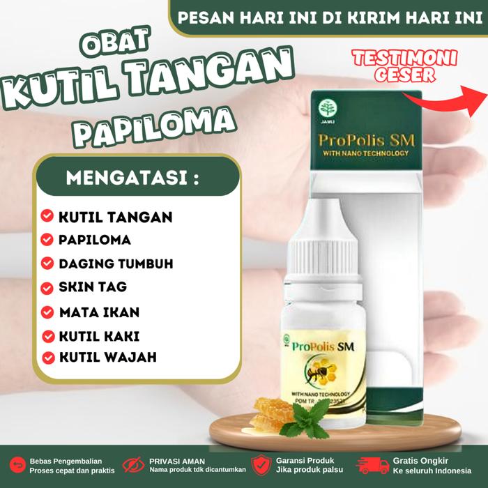 PROPOLIS SM - OBAT KUTIL TANGAN, OBAT PENGHILANG KUTIL, OBAT KUTIL DI KELOPAK MATA, OBAT KUTIL KAKI,