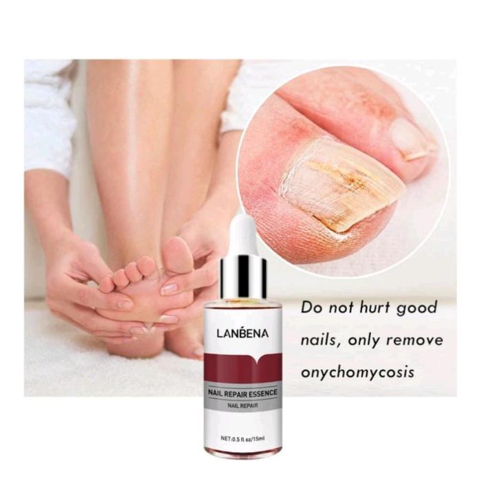Lanbena Nail Repair Essense Serum Perawatan Kuku Kaki Jamur Lanbena Nail