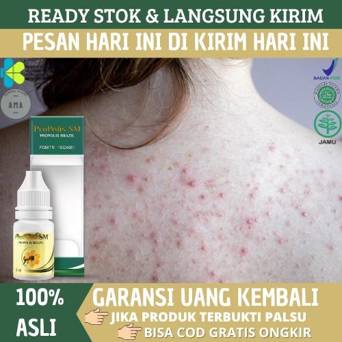 OBAT JERAWAT DI PUNGGUNG, OBAT PENGHILANG JERAWAT DI PUNGGUNG, OBAT JERAWAT DI PUNGGUNG DAN DADA, OB