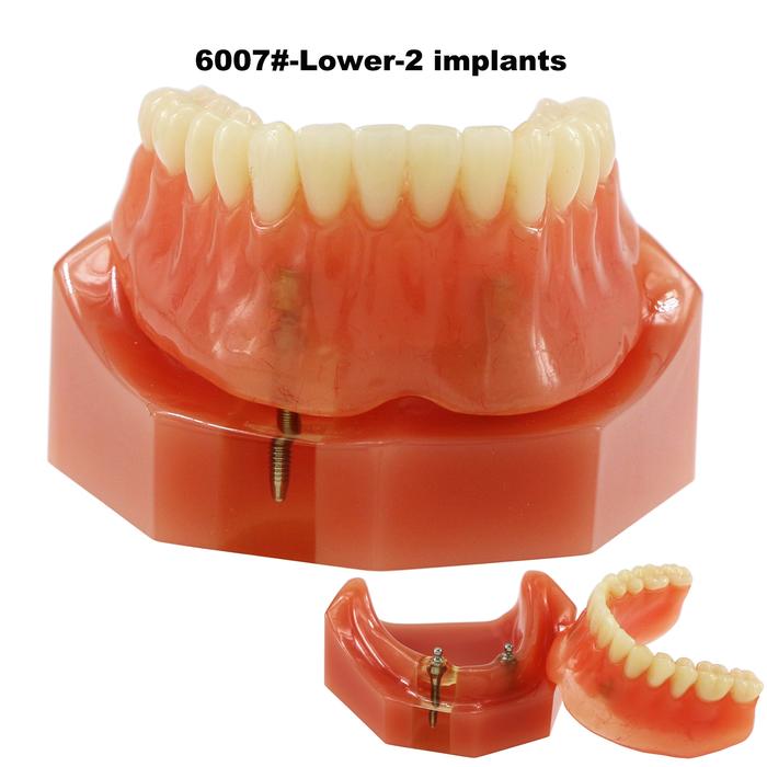 Model Gigi Implan Gigi M6007 Typodont Overdenture 2 Implan Rendah