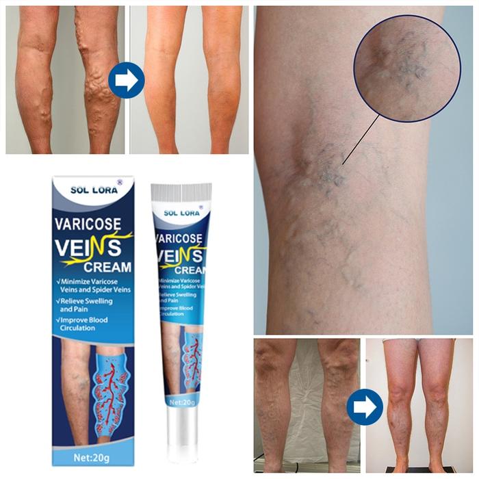 Varicose Veins Cream obat varises di kaki dan betis paling ampuh salep varises salep laba-laba Vasku