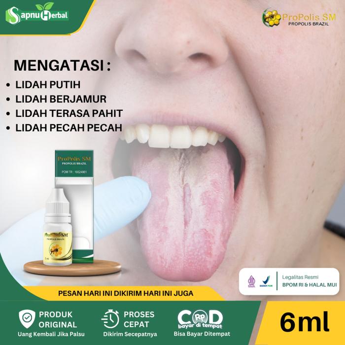 OBAT LIDAH PUTIH BERJAMUR, OBAT PENGHILANG BINTIK PUTIH DI LIDAH, OBAT PEMBERSIH LIDAH BERJAMUR, OBA