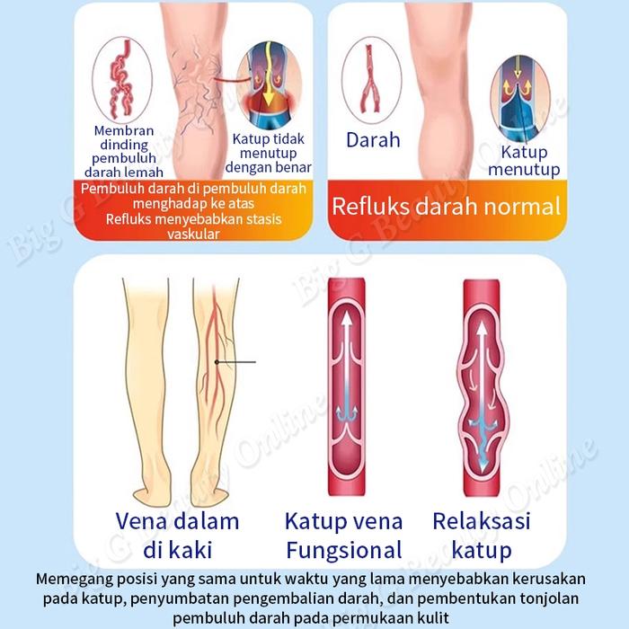 Varicose Veins Cream Salep Varises Paling Ampuh Obat Varises Di Kaki Dan Betis Menghilangkan Sakit K
