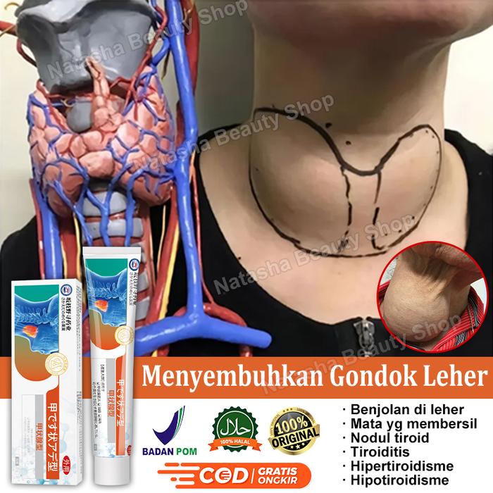 Krim Gondok Ampuh Obat Tiroid Salep Benjolan di Leher Obat Gondongan  20g 【Efektif dan Aman】Perawata