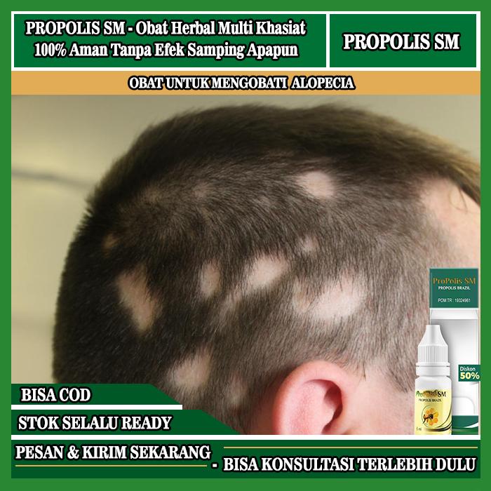 OBAT ALOPECIA AREATA, PENUMBUH RAMBUT PITAK PENYAKIT ALOPECIA, OBAT OLES KEBOTAKAN RAMBUT PADA KEPAL