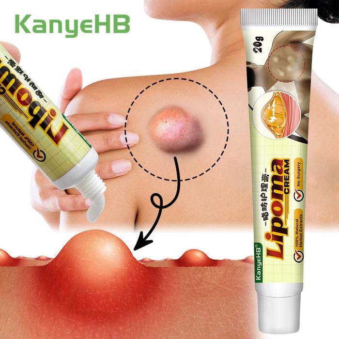 1Pcs Lipoma Removal Cream Removes Lipoma Fibroids Herbal Skin Swelling Cellulite Ointment Tumor Exfo