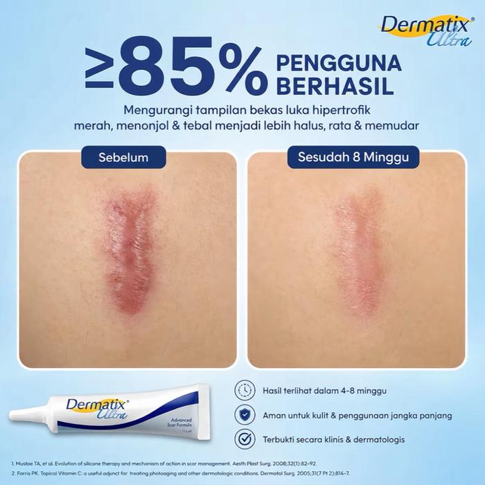 ￼COD Dermatik Ultra / Dermatic / Dermati Ultra 15Gr Cream Krim Penghilang Bekas Luka 15 gram strec a
