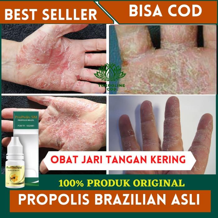 OBAT JARI TANGAN KERING, KULIT MENGELUPAS, TELAPAK TANGAN KASAR, JARI TANGAN PECAH PECAH, JARI TANGA