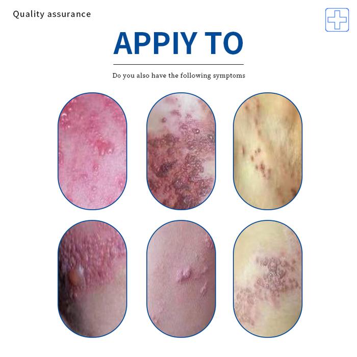 Herpes Zoster Treatment Spray Herpes Simplex Cure Shingles Skin Remover For Snake Sore Red Dot Blist