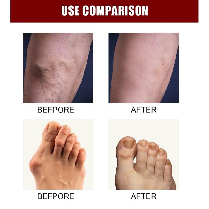 PERFECTX Joint Bone Therapy Krim Intensive Concentrate Cream Pengobatan Asam Urat Perfectx Cream 30g