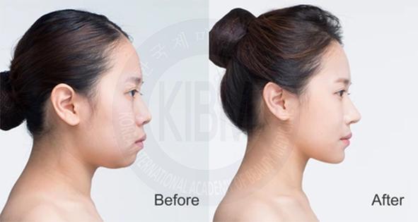 IMPLANT DAGU KOREA