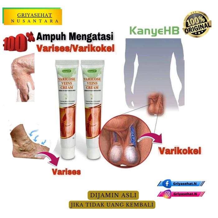 varicose cream,varises