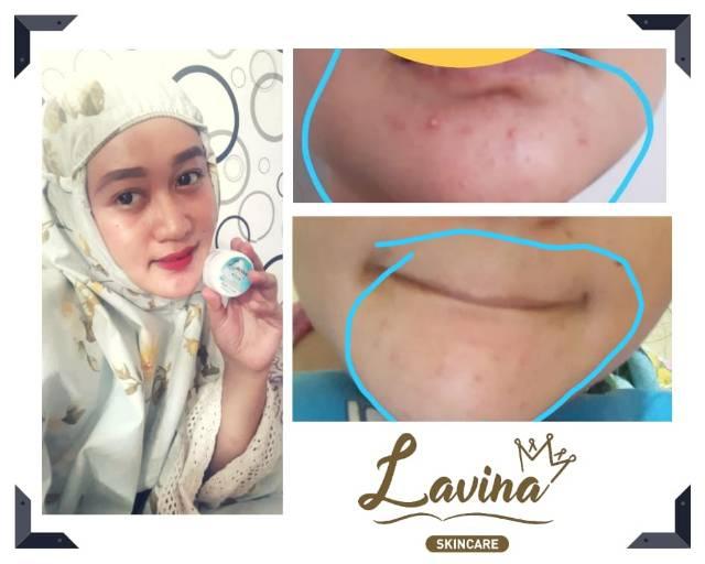 Terlaris! Cream Lavina Skincare Acne Kmn02