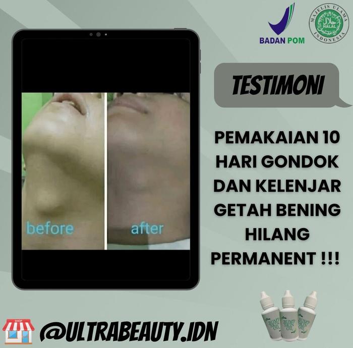 BENJOLAN HILANG 5 HARI PERMANEN TANPA OPERASI [BUMPSKIN OIL] | KELENJAR GETAH BENING | GONDOK | LIPO