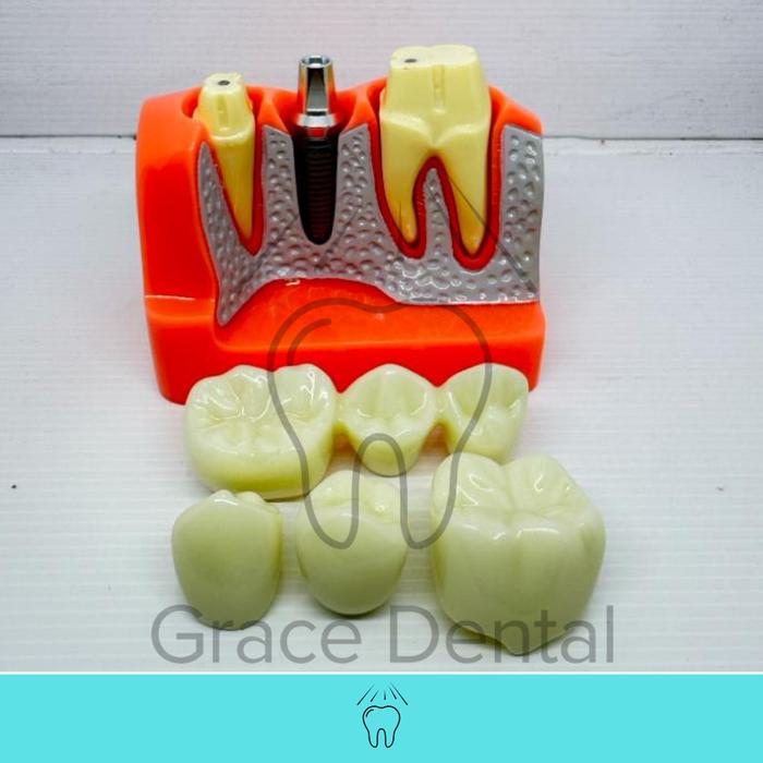 Model Implant Bridge Gigi Mahkota Jembatan Crown Dental