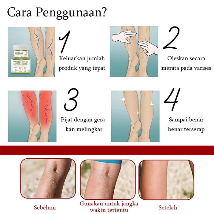 【HALAL & BPOM】EELHOE Varicose Veins Cream - 50ML / OBAT VARISES MEMULIHKAN KEMBALI PEMBULUH DARAH KA