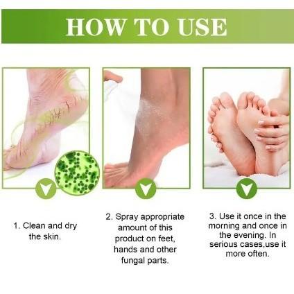 Hilangkan kutu air dalam 1 detik Obat bau kaki obat kaki gatal 30ml kaki akibat jamur Menghilangkan 