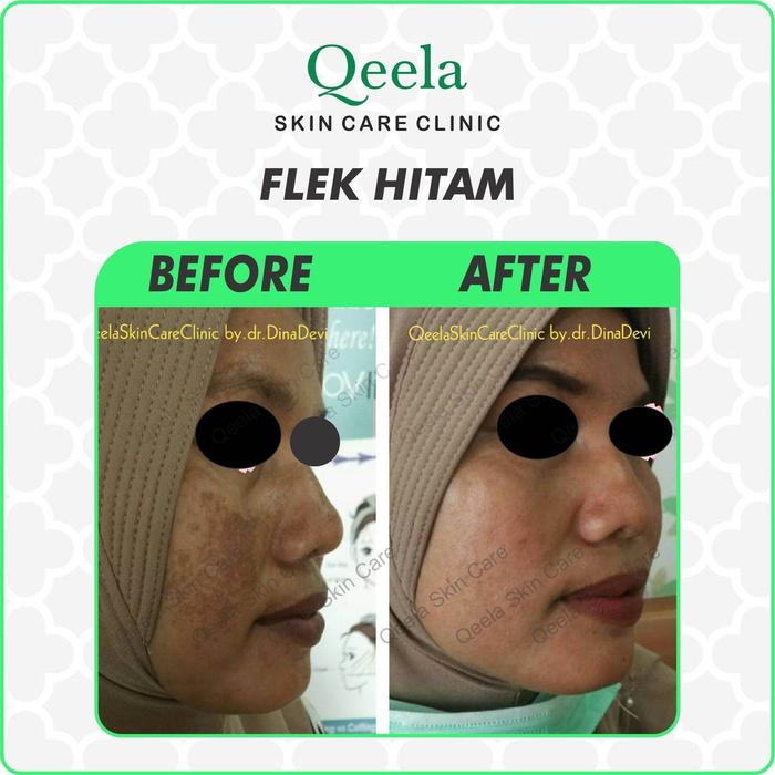 Qeela Skincare - KRIM MALAM BAGUS UNTUK FLEK HITAM / KRIM MALAM MELASMA / OBAT FLEK HITAM DI WAJAH /